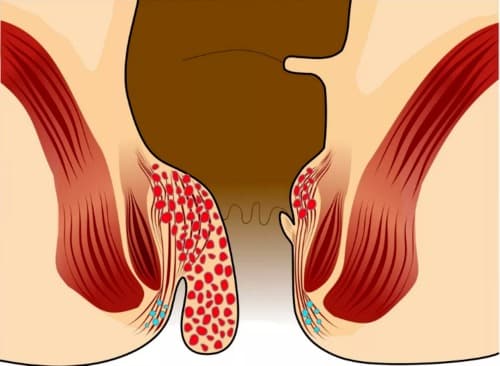 Hemofix dapatkah digunakan